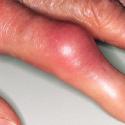 Артроз пальцев рук: симптомы и лечение