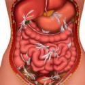 शस्त्रक्रियेनंतर आतडे आणि ओटीपोटाचे चिकटणे: ते कशामुळे होते आणि गर्भाशय काढून टाकल्यानंतर आसंजनांवर कसे उपचार करावे