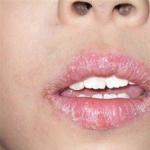 Припадъци в ъглите на устата: основните причини и лечение на язви при деца у дома, мнението на Комаровски Припадъци при дете на 6 години